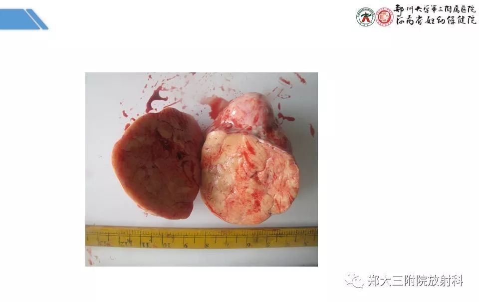 【PPT】卵巢肿瘤的影像诊断思路