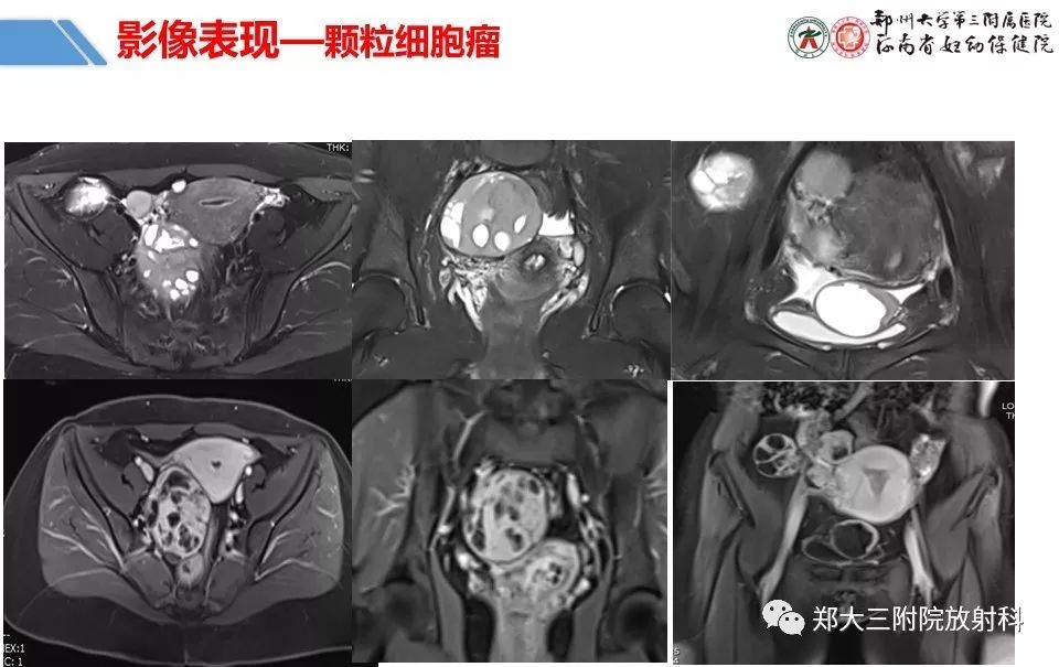 【PPT】卵巢肿瘤的影像诊断思路