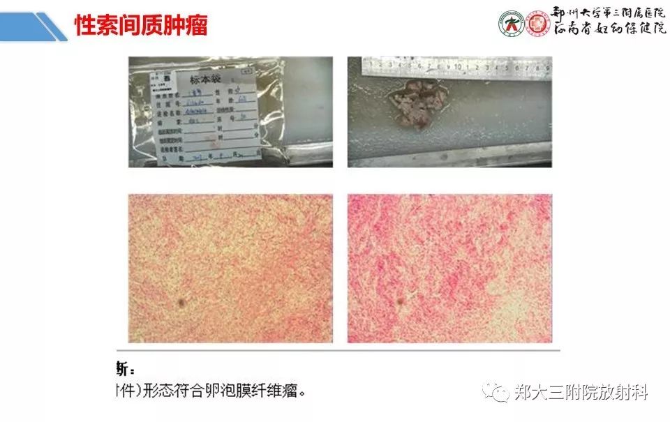 【PPT】卵巢肿瘤的影像诊断思路