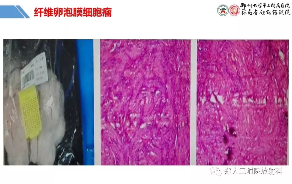 【PPT】卵巢肿瘤的影像诊断思路