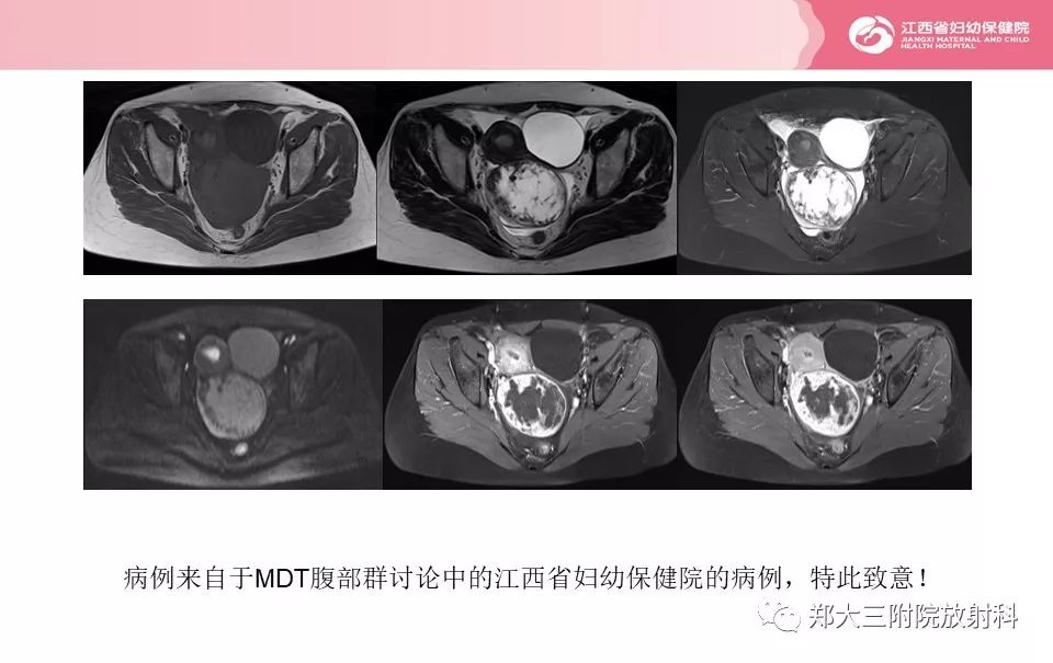 【PPT】卵巢肿瘤的影像诊断思路