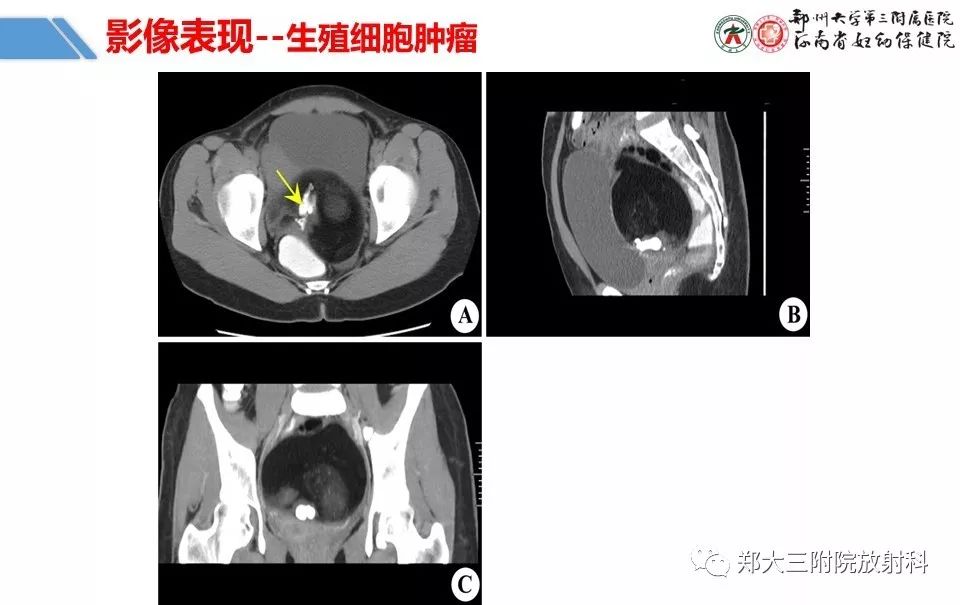 【PPT】卵巢肿瘤的影像诊断思路