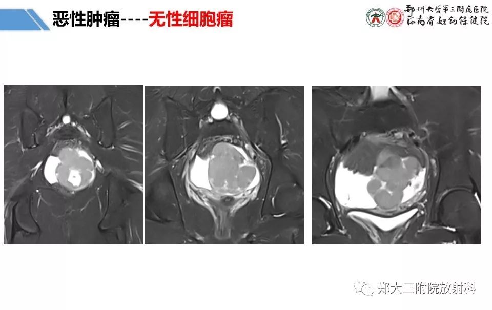 【PPT】卵巢肿瘤的影像诊断思路