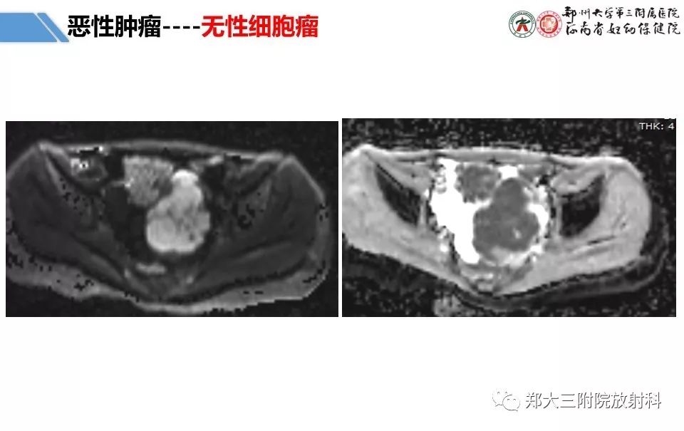 【PPT】卵巢肿瘤的影像诊断思路