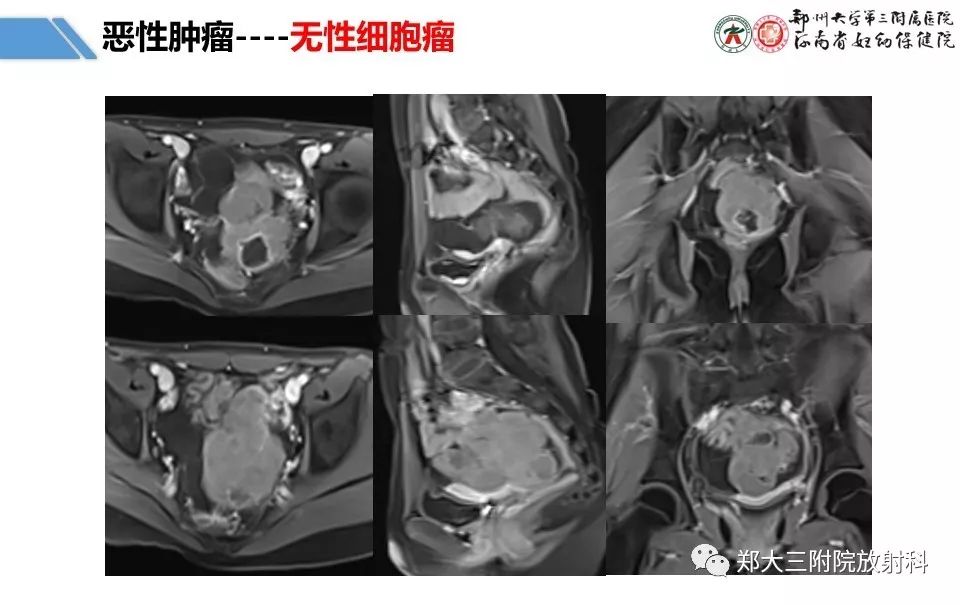 【PPT】卵巢肿瘤的影像诊断思路