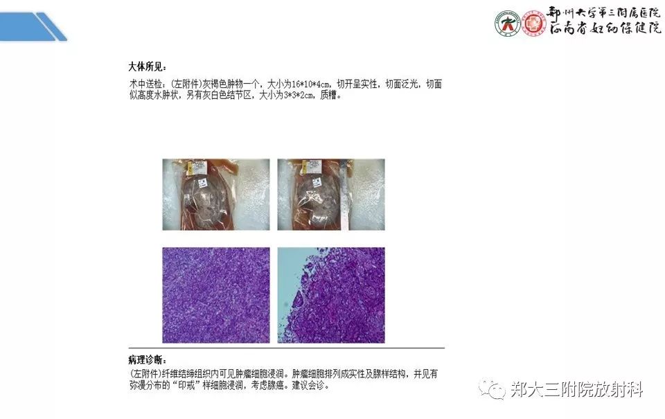 【PPT】卵巢肿瘤的影像诊断思路