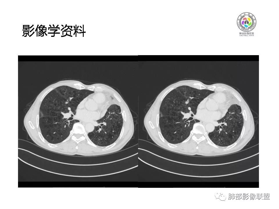 【病例】肺大细胞神经内分泌癌1例CT影像讨论 【病例】肺大细胞神经内分泌癌1例CT影像讨论