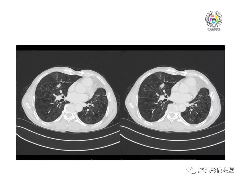【病例】肺大细胞神经内分泌癌1例CT影像讨论 【病例】肺大细胞神经内分泌癌1例CT影像讨论
