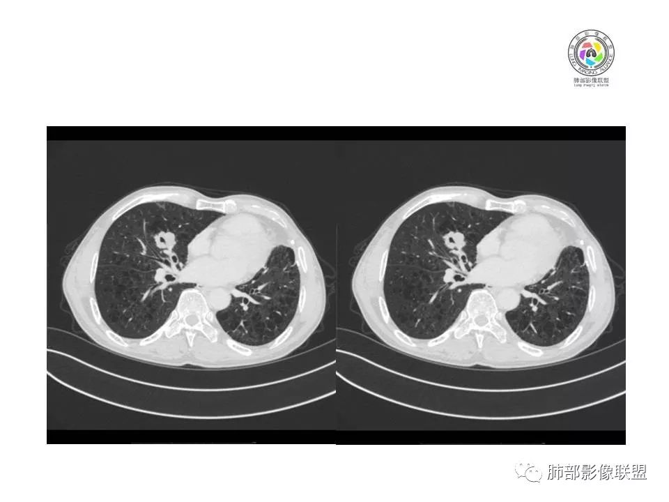 【病例】肺大细胞神经内分泌癌1例CT影像讨论 【病例】肺大细胞神经内分泌癌1例CT影像讨论