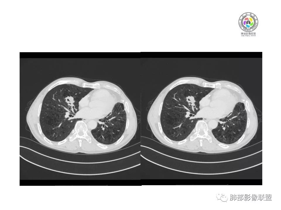【病例】肺大细胞神经内分泌癌1例CT影像讨论 【病例】肺大细胞神经内分泌癌1例CT影像讨论