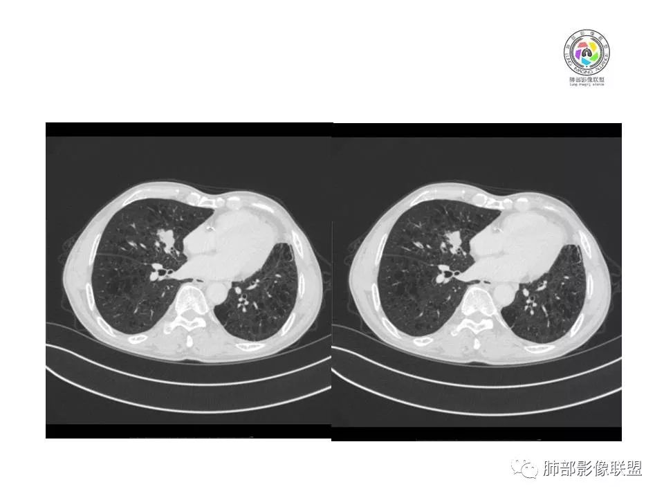 【病例】肺大细胞神经内分泌癌1例CT影像讨论 【病例】肺大细胞神经内分泌癌1例CT影像讨论