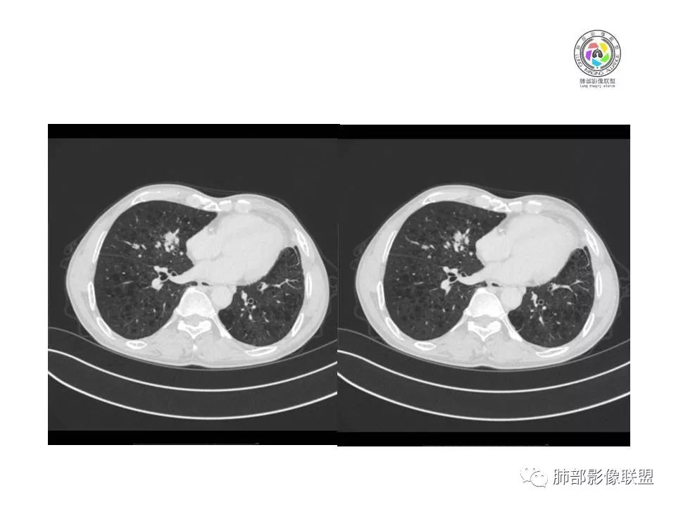 【病例】肺大细胞神经内分泌癌1例CT影像讨论 【病例】肺大细胞神经内分泌癌1例CT影像讨论