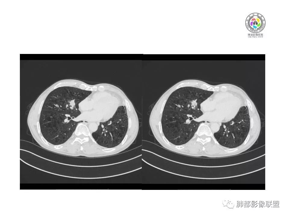 【病例】肺大细胞神经内分泌癌1例CT影像讨论 【病例】肺大细胞神经内分泌癌1例CT影像讨论