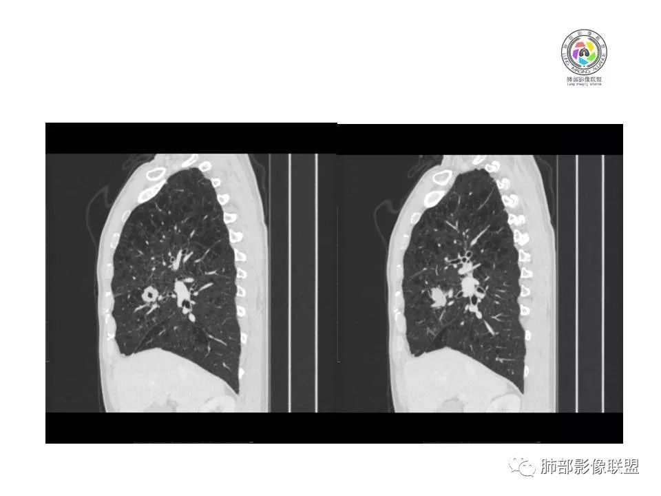 【病例】肺大细胞神经内分泌癌1例CT影像讨论 【病例】肺大细胞神经内分泌癌1例CT影像讨论