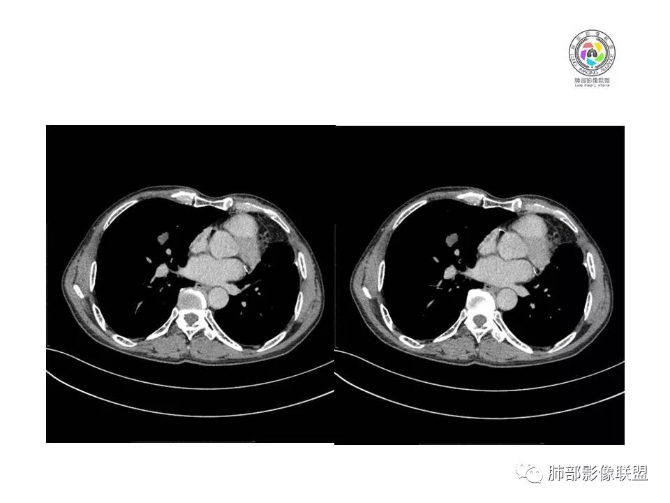 【病例】肺大细胞神经内分泌癌1例CT影像讨论 【病例】肺大细胞神经内分泌癌1例CT影像讨论