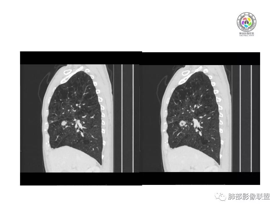 【病例】肺大细胞神经内分泌癌1例CT影像讨论 【病例】肺大细胞神经内分泌癌1例CT影像讨论