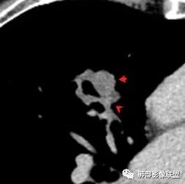 【病例】肺大细胞神经内分泌癌1例CT影像讨论 【病例】肺大细胞神经内分泌癌1例CT影像讨论