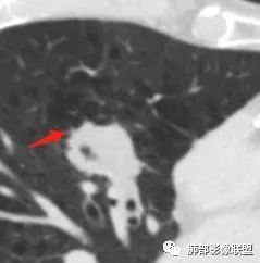 【病例】肺大细胞神经内分泌癌1例CT影像讨论 【病例】肺大细胞神经内分泌癌1例CT影像讨论