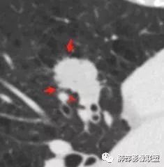 【病例】肺大细胞神经内分泌癌1例CT影像讨论 【病例】肺大细胞神经内分泌癌1例CT影像讨论