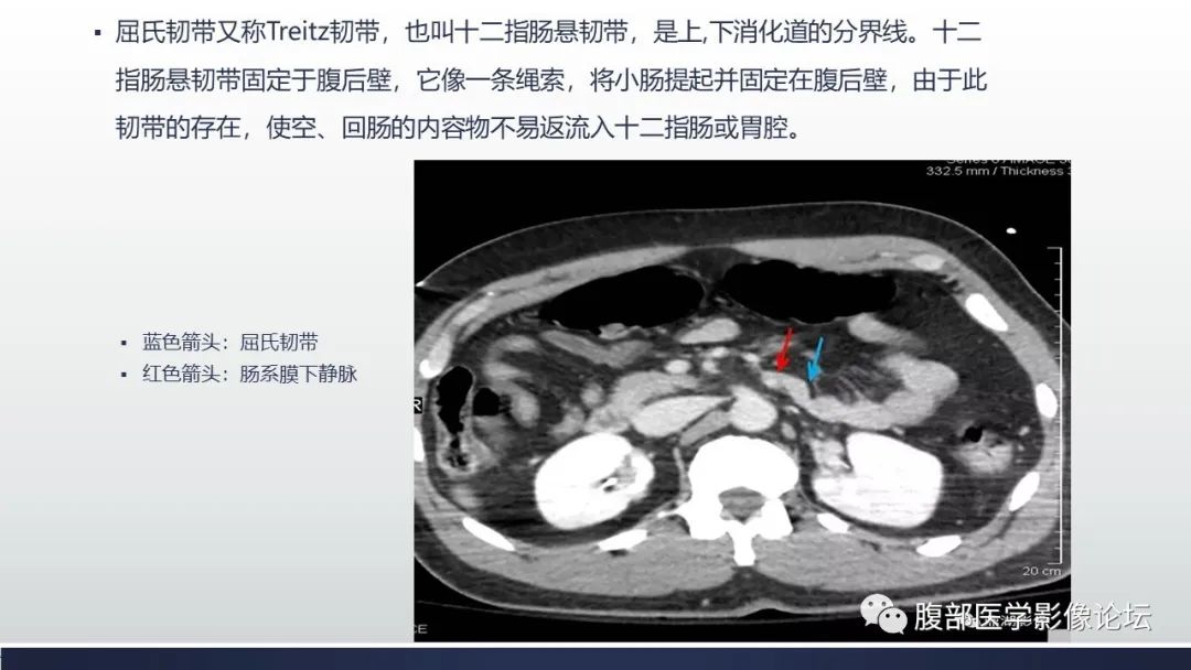 【病例】腹内疝1例CT影像诊断 【病例】腹内疝1例CT影像诊断