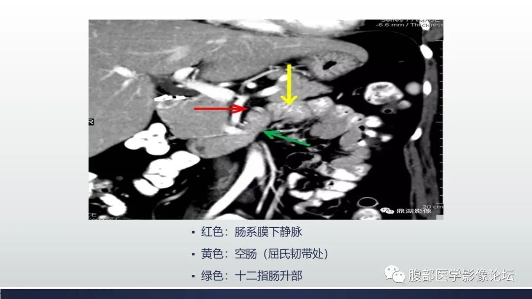 【病例】腹内疝1例CT影像诊断 【病例】腹内疝1例CT影像诊断