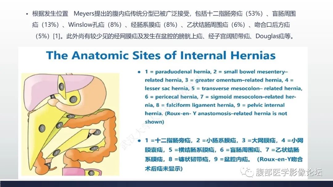 【病例】腹内疝1例CT影像诊断 【病例】腹内疝1例CT影像诊断