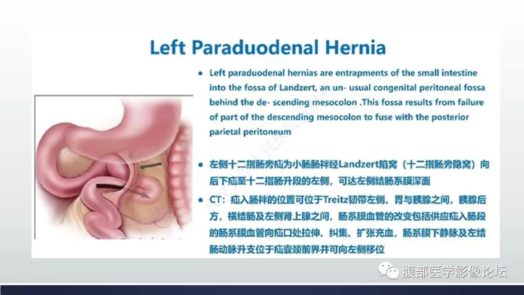 【病例】腹内疝1例CT影像诊断 【病例】腹内疝1例CT影像诊断