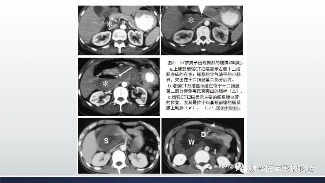 【病例】腹内疝1例CT影像诊断 【病例】腹内疝1例CT影像诊断