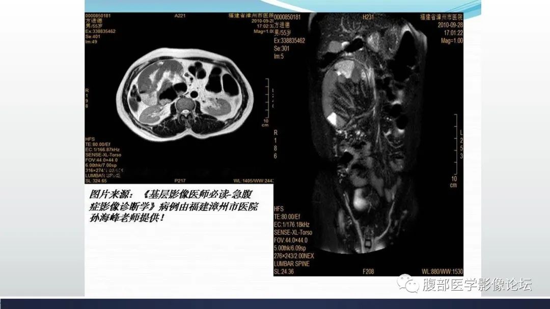 【病例】腹内疝1例CT影像诊断 【病例】腹内疝1例CT影像诊断