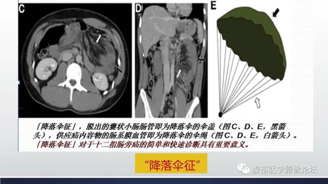 【病例】腹内疝1例CT影像诊断 【病例】腹内疝1例CT影像诊断