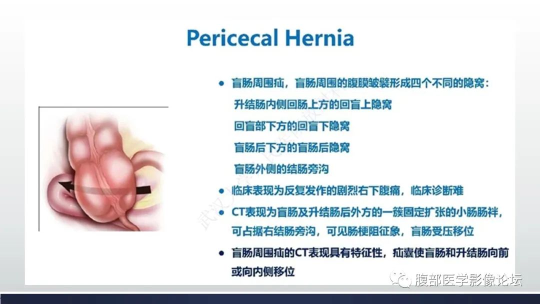 【病例】腹内疝1例CT影像诊断 【病例】腹内疝1例CT影像诊断