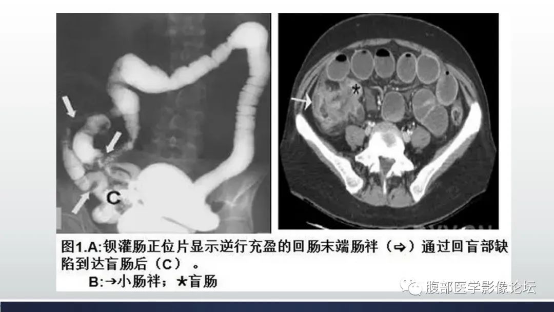 【病例】腹内疝1例CT影像诊断 【病例】腹内疝1例CT影像诊断