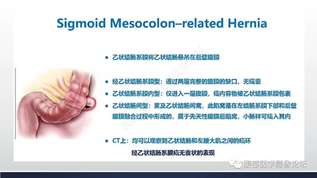 【病例】腹内疝1例CT影像诊断 【病例】腹内疝1例CT影像诊断