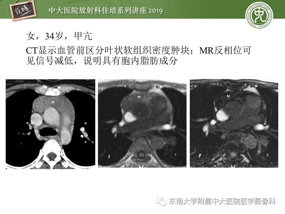 【PPT】胸腺上皮性肿瘤的影像诊断及鉴别