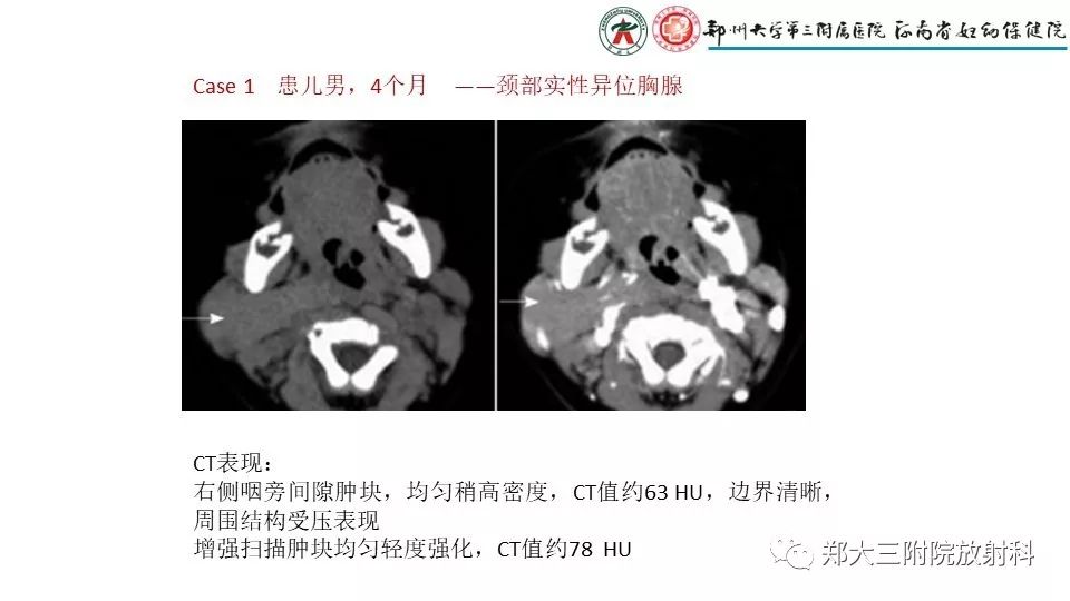 【病例】异位胸腺1例CT影像