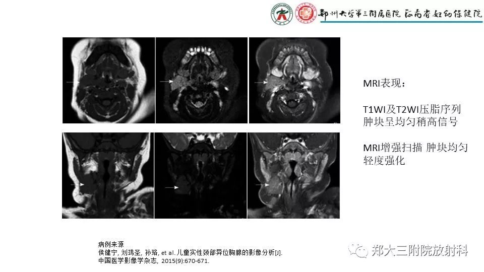 【病例】异位胸腺1例CT影像