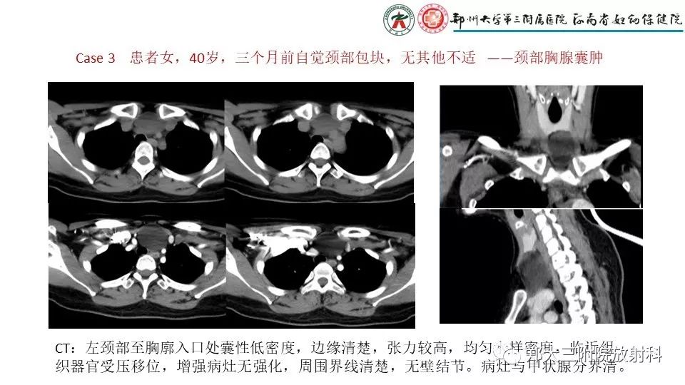 【病例】异位胸腺1例CT影像