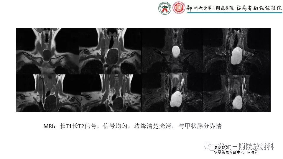 【病例】异位胸腺1例CT影像