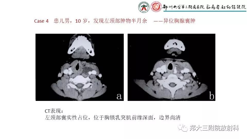 【病例】异位胸腺1例CT影像