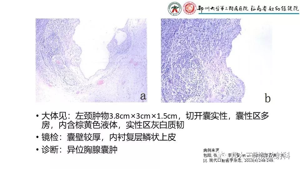 【病例】异位胸腺1例CT影像