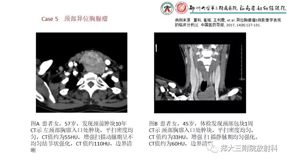 【病例】异位胸腺1例CT影像