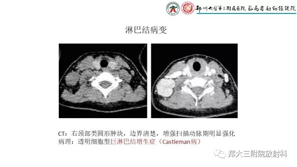 【病例】异位胸腺1例CT影像