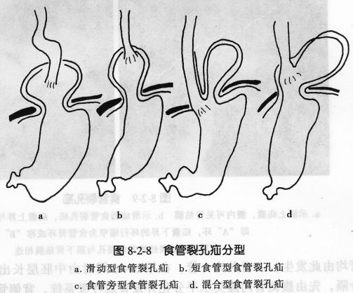食管疾病的X线造影 食管疾病的X线造影