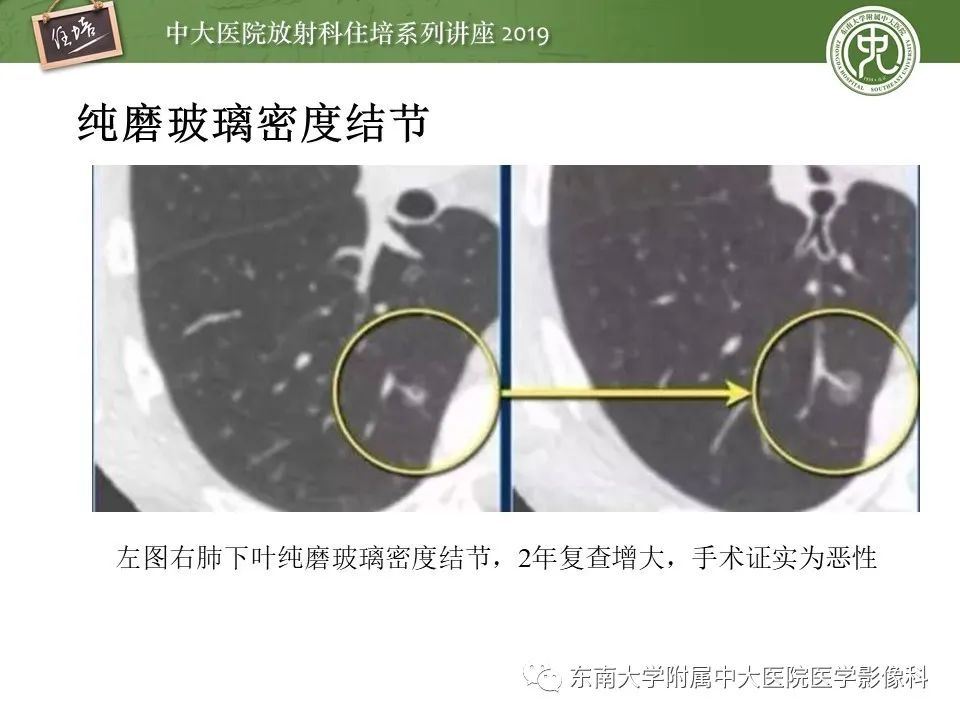 【PPT】肺结节的影像诊断及临床管理