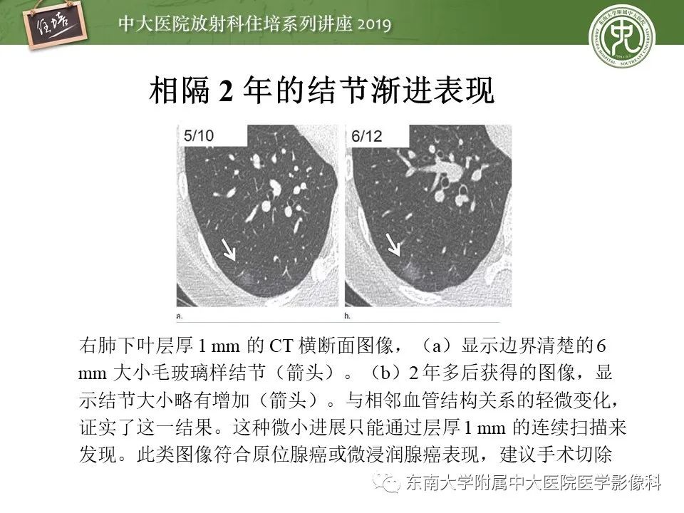 【PPT】肺结节的影像诊断及临床管理