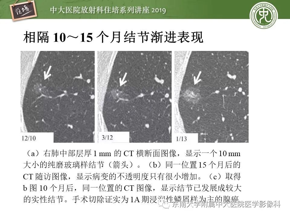 【PPT】肺结节的影像诊断及临床管理