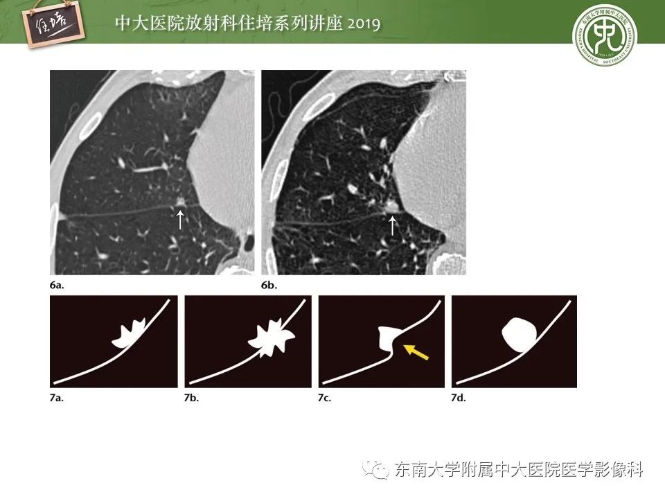 【PPT】肺结节的影像诊断及临床管理