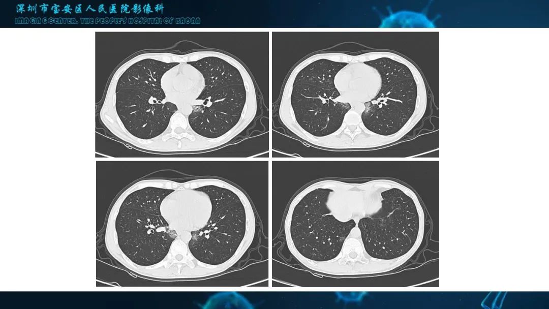 【PPT】输入性新型冠状病毒肺炎早期CT表现