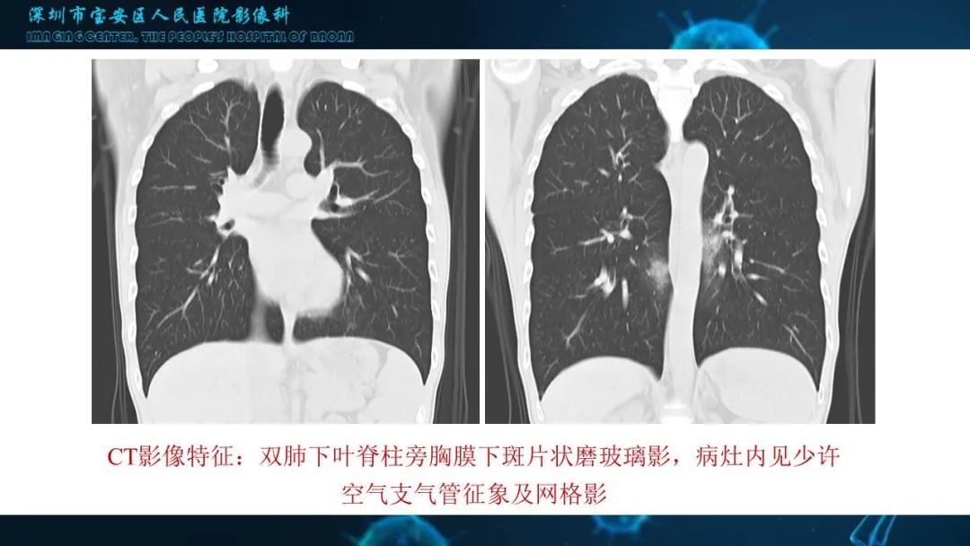 【PPT】输入性新型冠状病毒肺炎早期CT表现