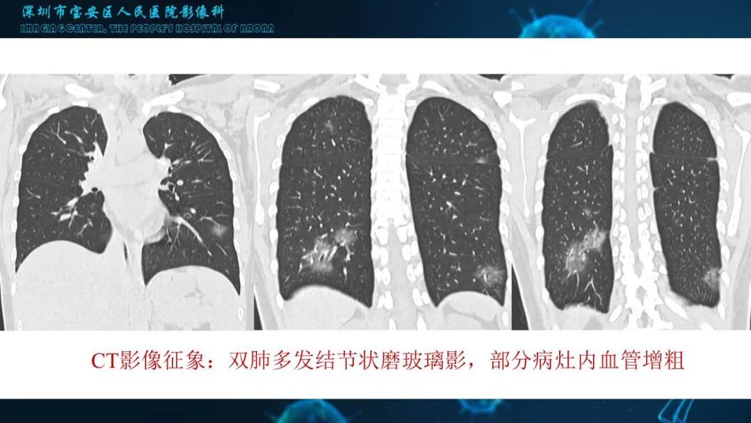 【PPT】输入性新型冠状病毒肺炎早期CT表现